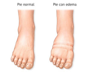 Pie con Edema - Masaje Linfático en Piernas