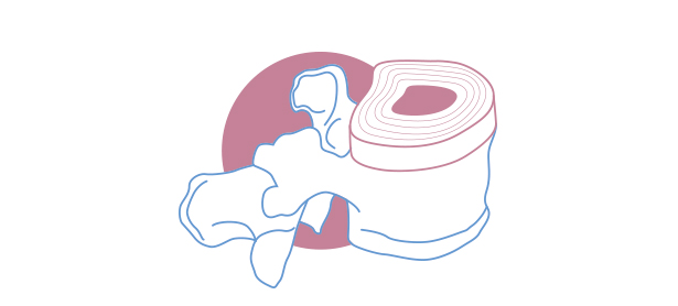 Qué es una protusión Discal
