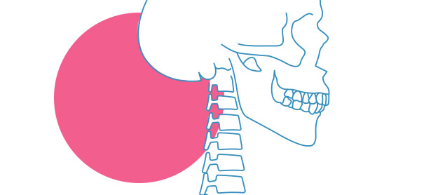 Rectificación Cervical - Tipos, Síntomas y Tratamientos