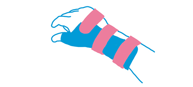 Muñequera para Tendinitis de Quervain o tenosinovitis