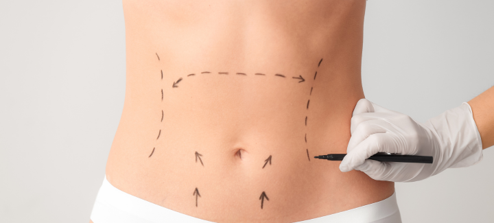 Fsioterapia tras cirugía estética