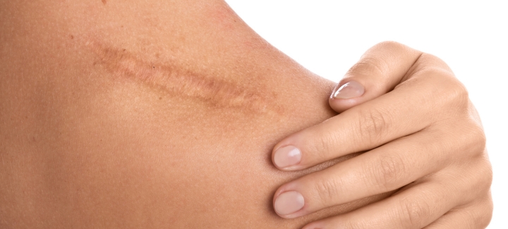 Plan Tratamiento de Cicatrices Fisioterapia Goya